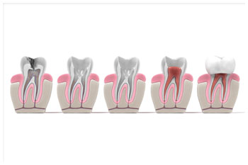 endodoncia
