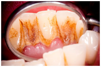 periodoncia1